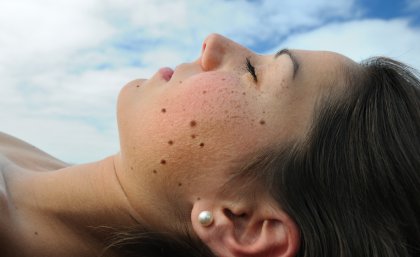 Half of all melanomas develop from a naevus Half of all melanomas develop from a naevus